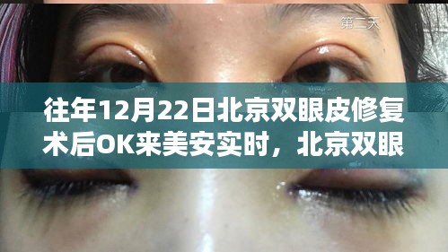 北京双眼皮修复术后恢复体验分享，美安实时跟踪记录与体验反馈